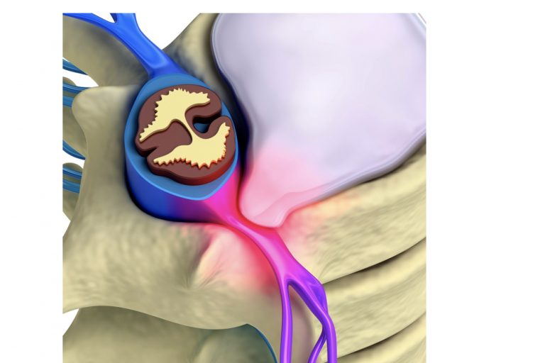 Suffering from a slipped disc? Contact us now, we can help!