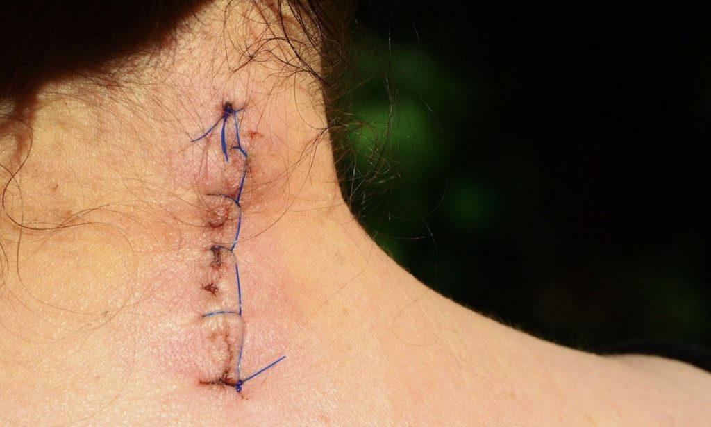 SCAR AFTER NECK SURGERY